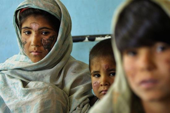 Two young girls and a boy with scars on their faces, caused by Leishmaniasis